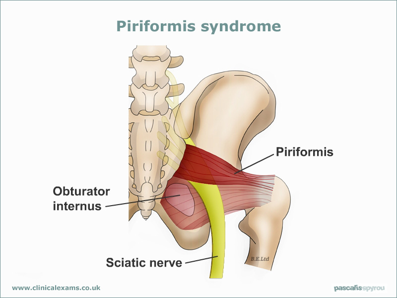 Piriformis Syndrome - Meadowlark Massage, Sheridan Wyoming